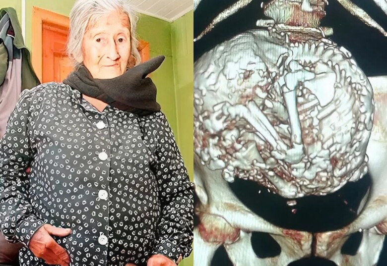 Ở tuổi 91, bà Estela phát hiện mang bào thai hoá đá hơn 60 năm.