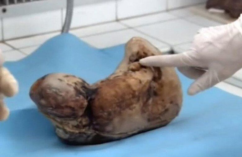 Một bào thai hoá đá từng được lấy khỏi người bệnh nhân.