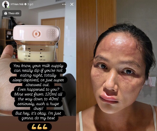 HHen Niê giảm 2/3 lượng sữa, trước đó bị nổi mề đay khiến mặt bị sưng.
