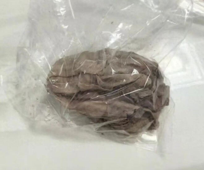 Miếng gạc bỏ quên trong bụng sản phụ suốt 50 ngày.