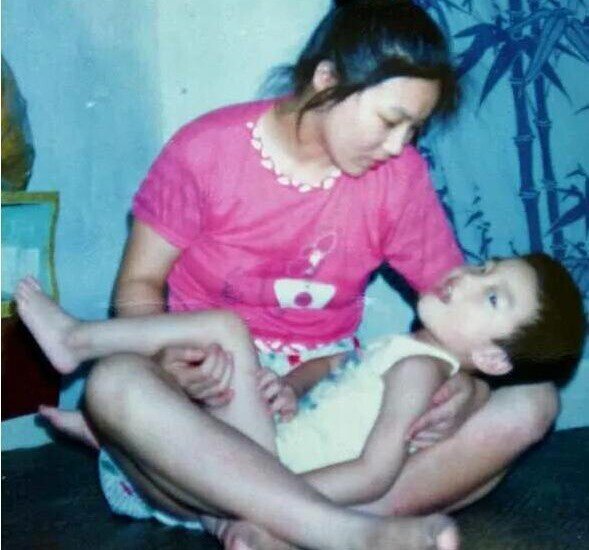 Đứa trẻ bị bại não sau ca sinh non, không thể tự đi lại - Ảnh minh hoạ.