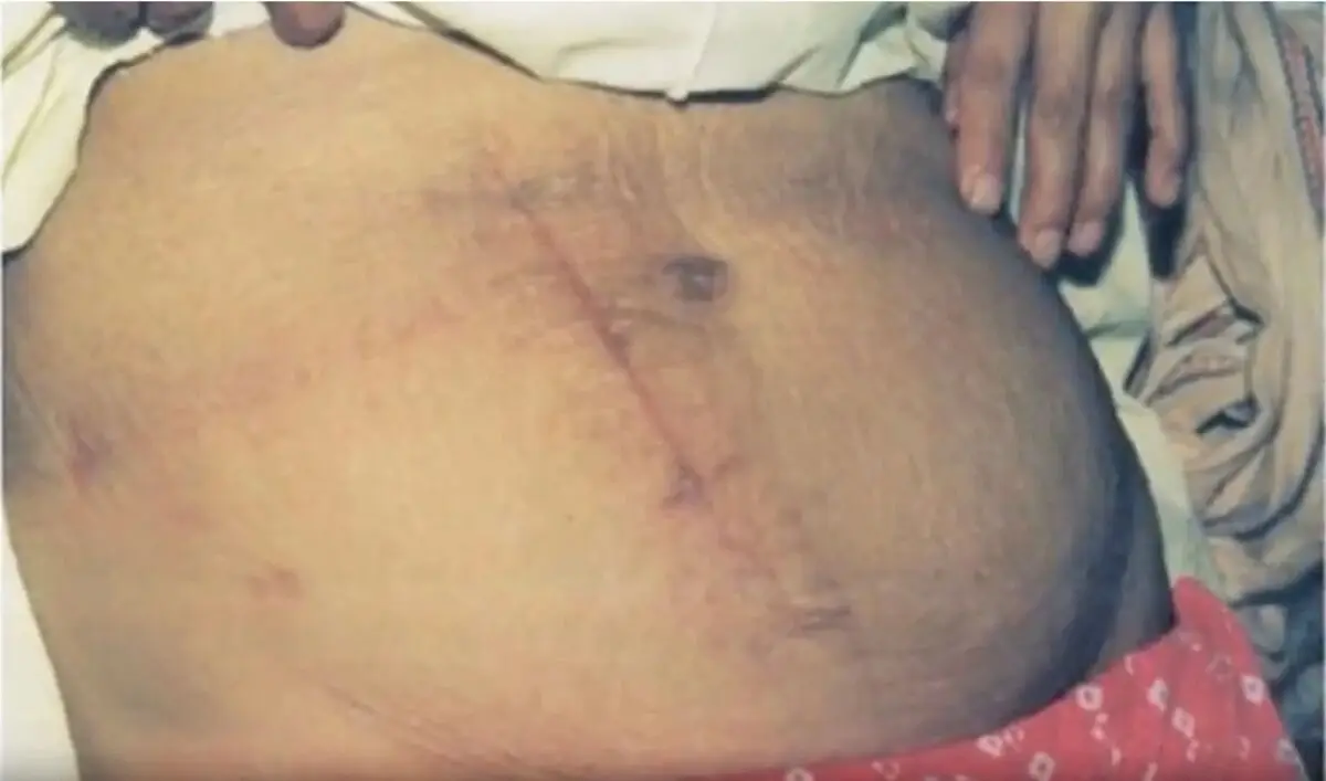 Vết sẹo dài 17cm của sản phụ sau ca sinh.