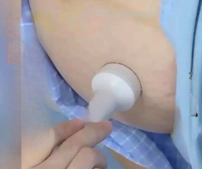 Hình ảnh được ghi lại ở viện, bác sĩ cố gắng dò tìm vị trí của túi thai cho bệnh nhân 40 tuổi.