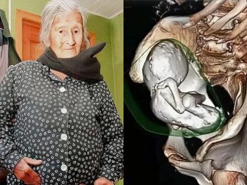 Chụp CT thấy vật thể lạ trong bụng cụ bà 73 tuổi, bác sĩ sững sờ phát hiện bào thai đá tồn tại suốt 30 năm