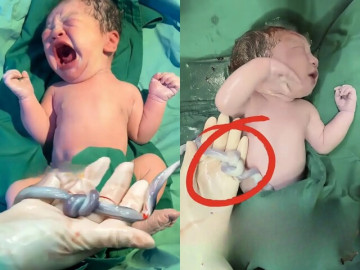 Em bé chào đời bên vật thể lạ khiến cả ê-kíp đứng tim, hành động tuyệt vời của mẹ khi mang bầu đã cứu lấy con