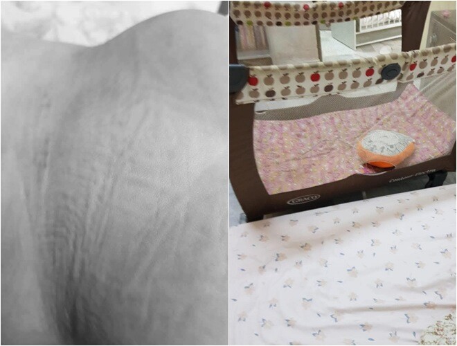 Toàn bộ mông của bé gái bị bầm tím và sưng tấy (ảnh trái) và hình ảnh chiếc nôi - nơi em bé được cho là bị ngã.