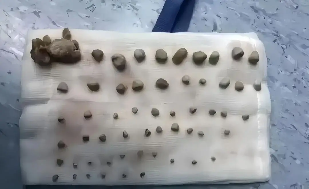 Bé gái 9 tuổi có 56 viên sỏi trong thận, BS chỉ ra nguyên nhân xuất phát từ thói quen sai lầm mà nhiều cha mẹ Việt hay mắc - 1