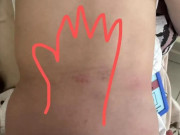 Mẹ âm thầm báo cảnh sát khi thấy vết lạ trên lưng con 14 tháng tuổi, kết quả khám khiến bà rụng rời chân tay