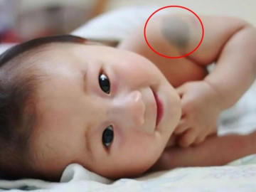 Đứa trẻ sở hữu vết bớt ở 10 vị trí này trên cơ thể báo hiệu số kiếp giàu sang phú quý, tương lai tiền tiêu không hết