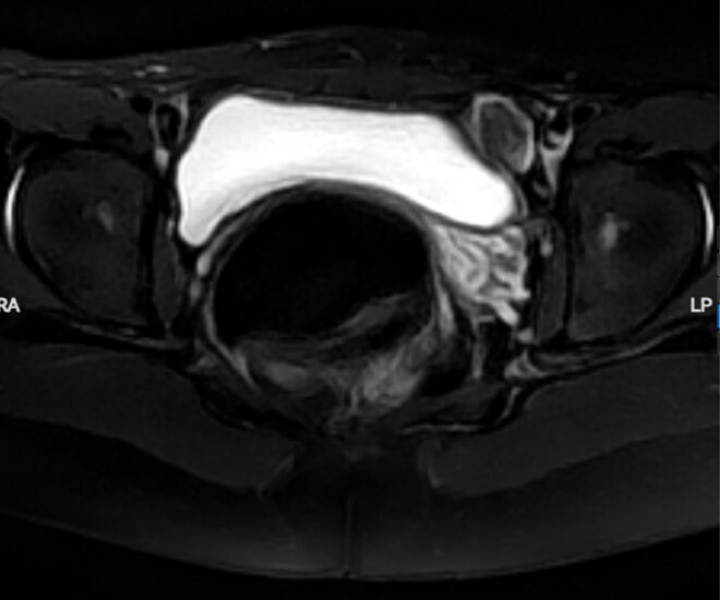 Hình ảnh cho thấy cô gái không có buồng trứng hai bên. Ảnh: BVCC.