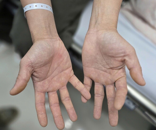 Bàn tay của bệnh nhân bị tê bì, không thể khép lại và mất cảm giác. 