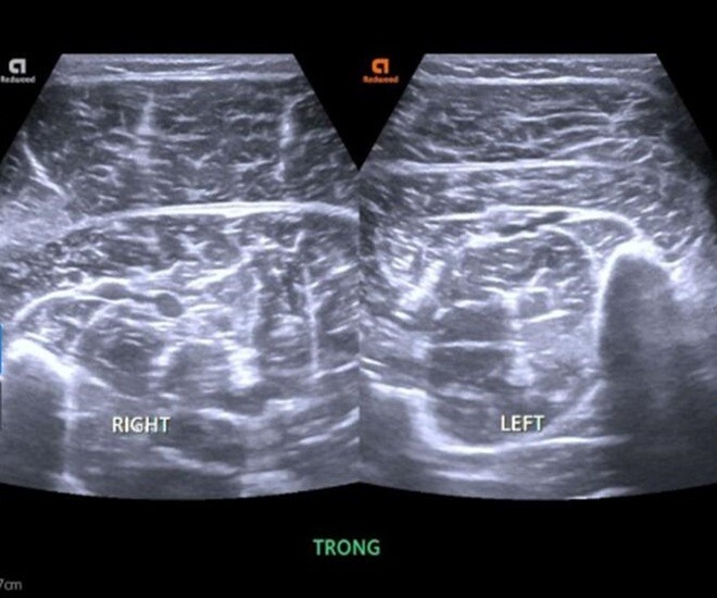 Hình ảnh bất thường tại chân phải của nam sinh mắc cúm A được phát hiện trên hình ảnh siêu âm phần mềm. Ảnh: BSCC. 