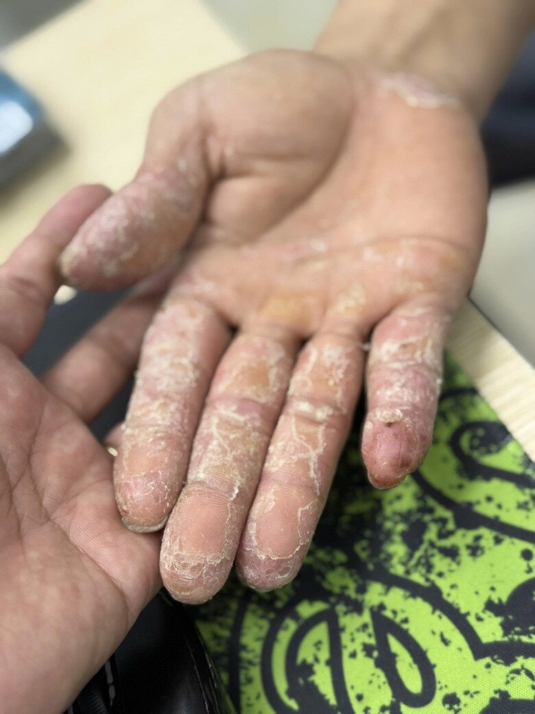 Một trường hợp bị tổn thương da tay sau khi tiếp xúc với nước ô nhiễm trong mùa mưa bão. Ảnh: BSCC.