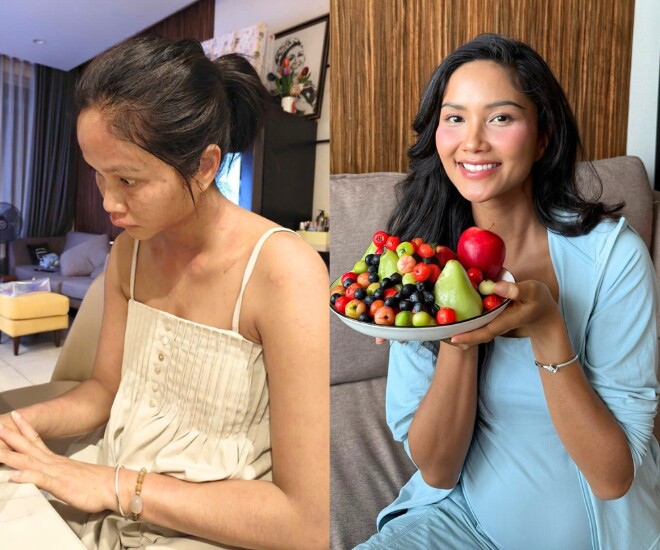 Tình trạng nổi mề đay, sưng tấy cả mặt của HHen Niê.