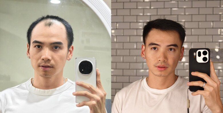 Nhiếp ảnh gia Tuấn Khôi khoe diện mạo mới sau 6 tháng cải thiện tình trạng hói tóc.