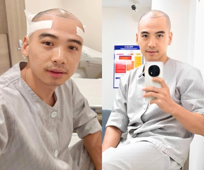 Chồng HHen Niê quyết định phẫu thuật cấy tóc hồi tháng 5/2025.