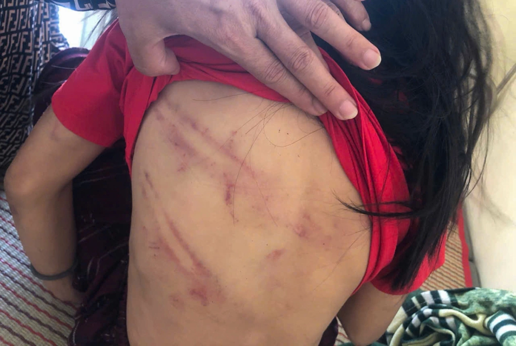 Vết thương trên người bé gái. Ảnh: Hùng Lê