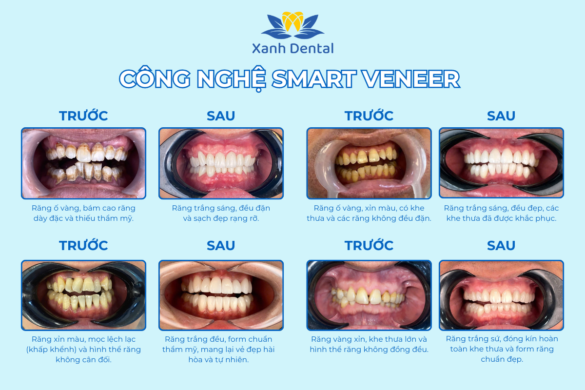 Công nghệ Veneer bước đột phá trong phục hình răng thẩm mỹ sinh học tại Xanh Dental - 1