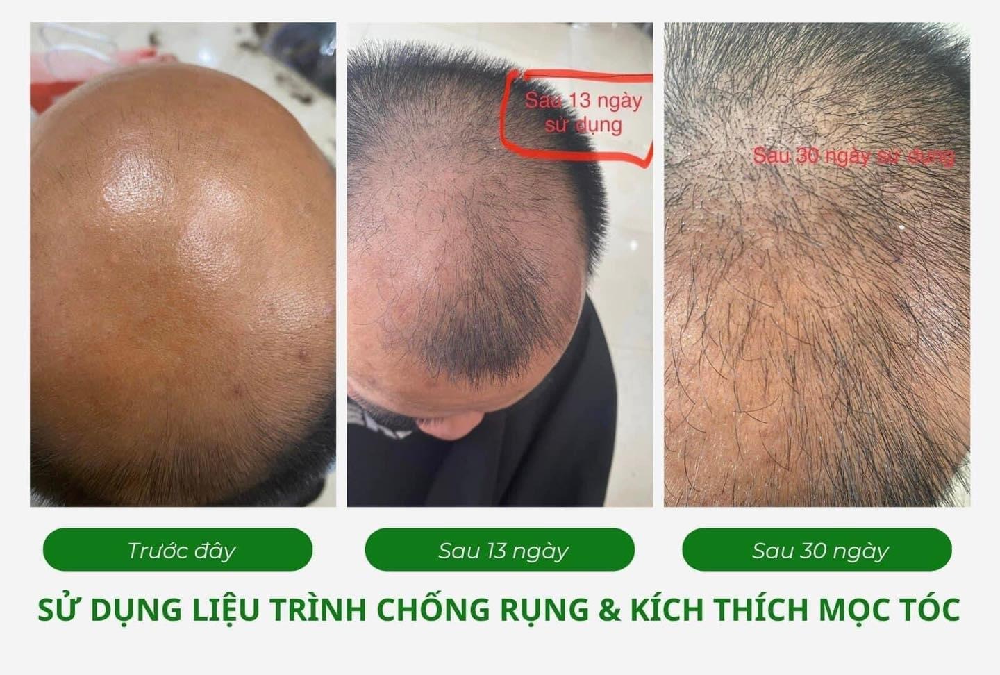 Mái tóc khỏe dày không khó: Giải pháp 2 bước chuyên sâu ngăn rụng tóc hiệu quả tại nhà - 4