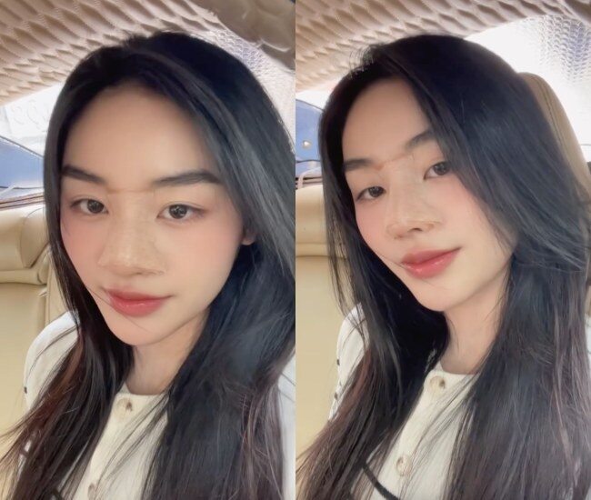 Miss Grand Vietnam 2025 công khai nâng mũi và sửa ngực sau 2 tháng đăng quang.