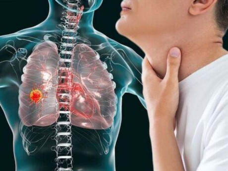 Thiếu niên hỏng phổi, suy thận nặng khi tập tành thể hiện "đẳng cấp" bằng thuốc lá điện tử