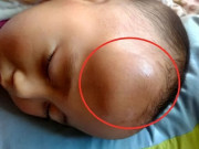Yêu con - Bé 1 tuổi ngã, trên đầu hiện khối u lớn, cách xử lý của người mẹ bất ngờ nhận lời khen từ bác sĩ