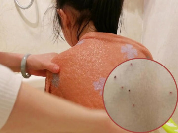 Thấy trên lưng con gái chằng chịt lỗ nhỏ khi tắm cho bé, người mẹ phát hiện sự thật đáng sợ ở trường liền báo cảnh sát