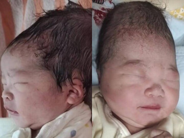 Con sơ sinh chào đời có dáng đầu dài bất thường, bố mẹ phát hoảng cầu cứu bác sĩ