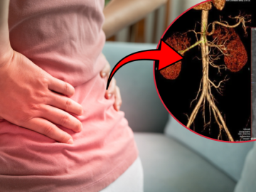 Đi khám vì đau hông lưng, phát hiện túi phình động mạch thận kích thước lớn
