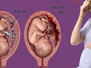 Bà bầu - Nhau bong non nguy hiểm như thế nào?