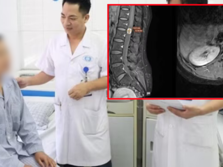 Đau lưng đến mất ngủ, người phụ nữ 39 tuổi đi khám phát hiện u tủy