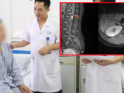 Clip Eva - Đau lưng đến mất ngủ, người phụ nữ 39 tuổi đi khám phát hiện u tủy