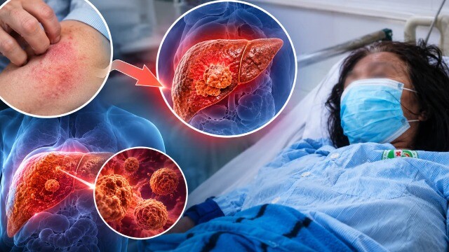 Tưởng dị ứng hải sản, người phụ nữ 45 tuổi bàng hoàng được phát hiện mắc ung thư gan nặng