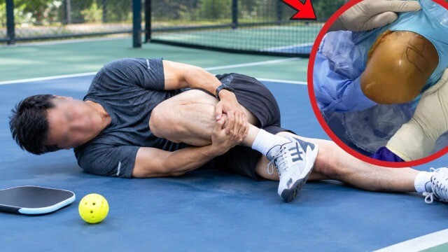Chơi pickleball, người đàn ông ngoài 40 tuổi bị đứt hoàn toàn gân gót chân