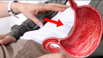 Không dấu hiệu cảnh báo, người đàn ông sốc khi phát hiện ung thư dạ dày