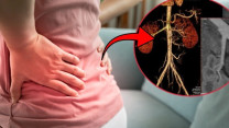 Đi khám vì đau hông lưng, phát hiện túi phình động mạch thận kích thước lớn