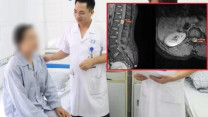 Đau lưng đến mất ngủ, người phụ nữ 39 tuổi đi khám phát hiện u tủy