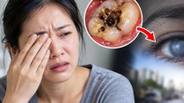 Người phụ nữ 35 tuổi suýt mất thị lực vì ổ sâu răng lâu năm