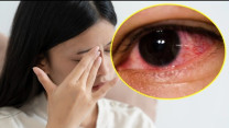 Mắt trái sưng đỏ kèm đau đầu, bác sĩ phát hiện nguyên nhân ít ai ngờ