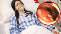 Nữ vận động viên 23 tuổi phát hiện ung thư đại tràng từ dấu hiệu đau bụng