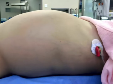 Bà bầu - Thấy con gái 10 tuổi bụng nhô to suốt 2 tháng, bố mẹ đưa đi khám thì ngã ngửa trước kết quả chụp CT
