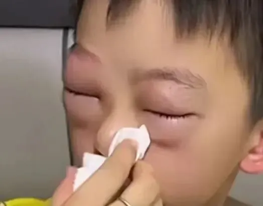 Mẹ hốt hoảng vì mắt con sưng to như quả trứng gà, nguyên nhân phía sau ai cũng amp;#34;dở khóc dở cườiamp;#34; - 2