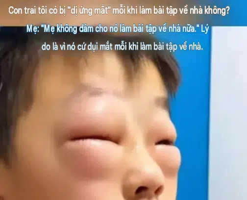 Mẹ hốt hoảng vì mắt con sưng to như quả trứng gà, nguyên nhân phía sau ai cũng amp;#34;dở khóc dở cườiamp;#34; - 1