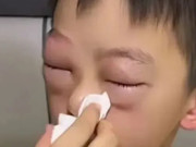 Yêu con - Mẹ hốt hoảng vì mắt con sưng to như quả trứng gà, nguyên nhân phía sau ai cũng "dở khóc dở cười"