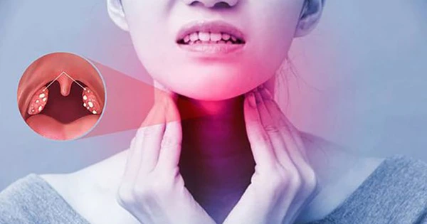 Đau họng có mủ có thể do vi khuẩn, nhưng có thể do nhiều nguyên nhân khác. Ảnh minh họa.