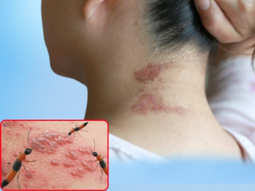 Sức khỏe - Kiến ba khoang vào mùa khiến cuộc sống người dân bị đảo lộn, nhiều người nhầm lẫn với zona thần kinh