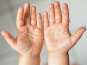 Sức khỏe - TP.HCM ghi nhận số trẻ mắc tay chân miệng tăng mạnh